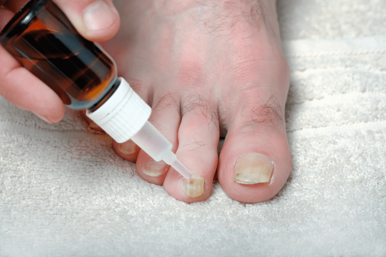 Onicomicose – Fungos nas Unhas