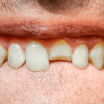 Dente partido: o que fazer