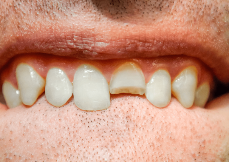 Dente partido: o que fazer